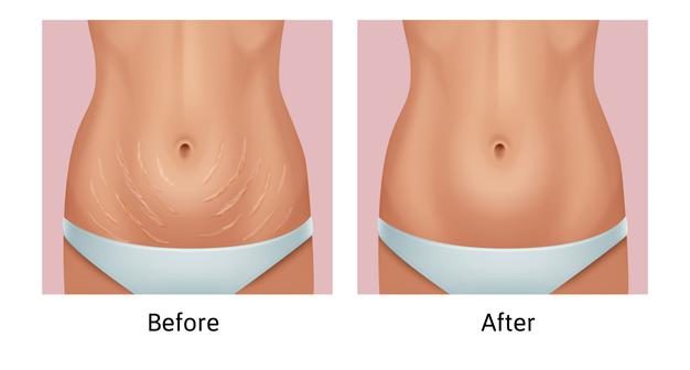 Eliminar el exceso de grasa del abdomen, mujer antes y después